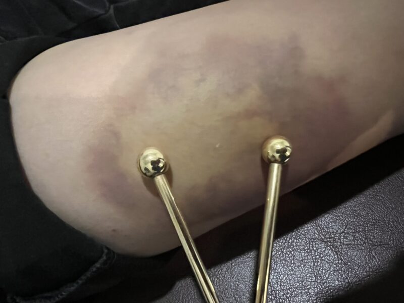 【10代】階段から落ちて痛みのある患者さん