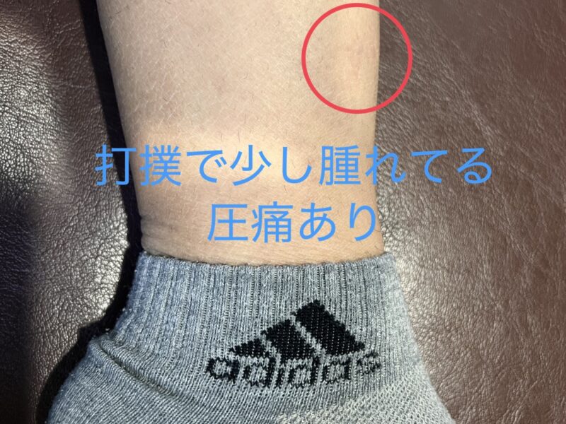 スポーツ中打撲をしてしまった患者様